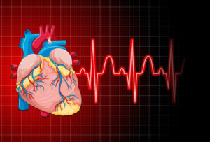 Heartbeat showing atrial fibrilattion